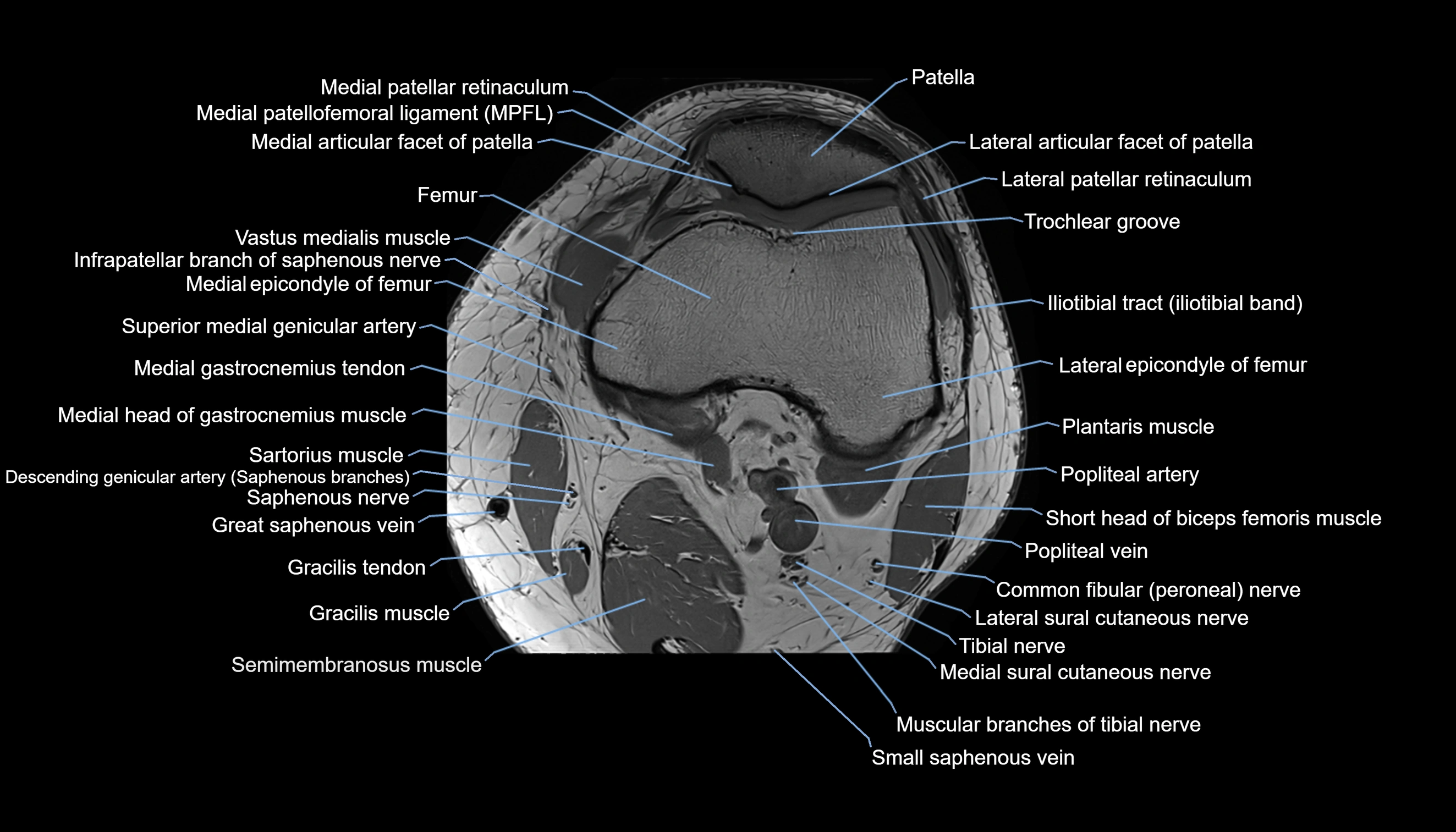 MRI knee  axial cross sectional anatomy 3T radiology  image-img-00001-00015.webp
